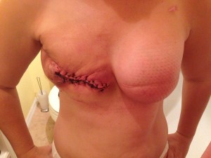 necrotic breast is removed