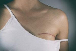 breast reconstruction after radiation