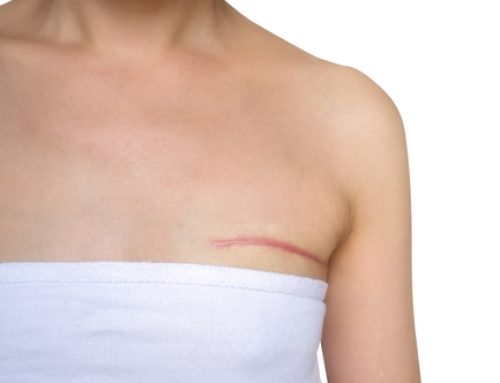 How to Avoid Breast Surgery Scars: Get Hidden Scar Surgery!